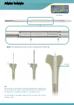 Preview for 14 page of Surgival Genutech CCK Surgical Technique