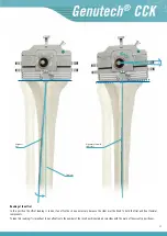 Preview for 19 page of Surgival Genutech CCK Surgical Technique