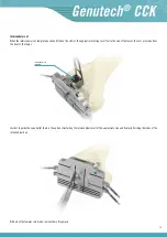 Preview for 21 page of Surgival Genutech CCK Surgical Technique