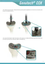 Preview for 27 page of Surgival Genutech CCK Surgical Technique