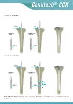 Preview for 35 page of Surgival Genutech CCK Surgical Technique