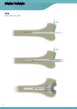 Preview for 36 page of Surgival Genutech CCK Surgical Technique