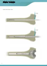 Preview for 38 page of Surgival Genutech CCK Surgical Technique