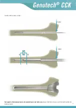 Preview for 39 page of Surgival Genutech CCK Surgical Technique