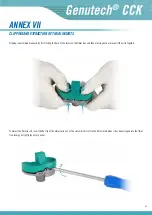 Preview for 43 page of Surgival Genutech CCK Surgical Technique