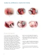 Preview for 12 page of Synthes Delta Xtend Manual