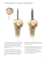 Preview for 13 page of Synthes Delta Xtend Manual