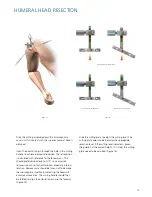 Preview for 15 page of Synthes Delta Xtend Manual