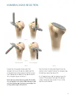 Preview for 17 page of Synthes Delta Xtend Manual