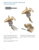 Preview for 26 page of Synthes Delta Xtend Manual