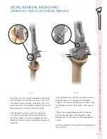 Preview for 33 page of Synthes Delta Xtend Manual