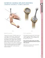 Preview for 47 page of Synthes Delta Xtend Manual