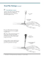 Предварительный просмотр 10 страницы Synthes Dorsal Manual