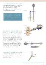 Preview for 15 page of Synthes EXPEDIUM VERSE System Manual