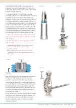 Preview for 25 page of Synthes EXPEDIUM VERSE System Manual