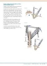 Preview for 29 page of Synthes EXPEDIUM VERSE System Manual