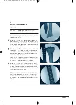 Preview for 13 page of Synthes Expert Tibial Nail Technique Manual