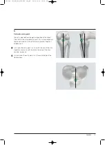 Preview for 15 page of Synthes Expert Tibial Nail Technique Manual