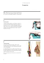 Preview for 8 page of Synthes LCP Distal Humerus Plates Technique Manual