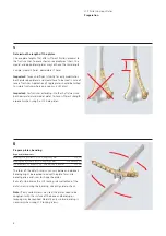 Preview for 10 page of Synthes LCP Distal Humerus Plates Technique Manual