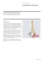 Preview for 11 page of Synthes LCP Distal Humerus Plates Technique Manual