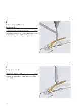 Preview for 12 page of Synthes LCP Distal Humerus Plates Technique Manual