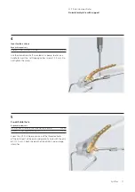 Preview for 13 page of Synthes LCP Distal Humerus Plates Technique Manual