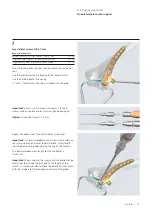 Preview for 15 page of Synthes LCP Distal Humerus Plates Technique Manual