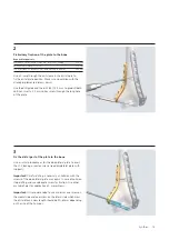 Preview for 17 page of Synthes LCP Distal Humerus Plates Technique Manual