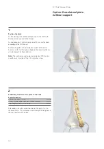 Preview for 20 page of Synthes LCP Distal Humerus Plates Technique Manual