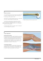 Предварительный просмотр 17 страницы Synthes LISS DF Technique Manual