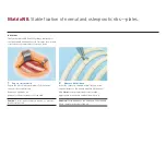 Preview for 3 page of Synthes MatrixRIB Quick Reference