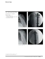 Preview for 9 page of Synthes MultiLoc Proximal Humeral Nail Technique Manual