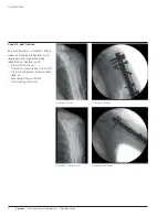 Preview for 10 page of Synthes MultiLoc Proximal Humeral Nail Technique Manual