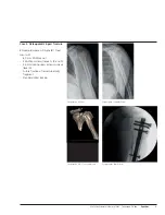 Preview for 11 page of Synthes MultiLoc Proximal Humeral Nail Technique Manual