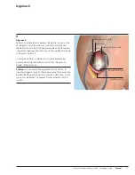 Preview for 13 page of Synthes MultiLoc Proximal Humeral Nail Technique Manual