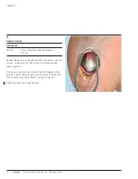 Preview for 14 page of Synthes MultiLoc Proximal Humeral Nail Technique Manual