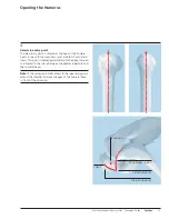 Preview for 15 page of Synthes MultiLoc Proximal Humeral Nail Technique Manual