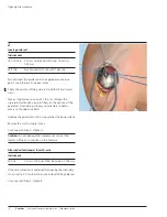 Preview for 16 page of Synthes MultiLoc Proximal Humeral Nail Technique Manual