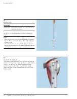 Preview for 38 page of Synthes MultiLoc Proximal Humeral Nail Technique Manual