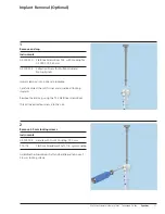 Preview for 39 page of Synthes MultiLoc Proximal Humeral Nail Technique Manual