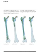 Предварительный просмотр 9 страницы Synthes TFN Technique Manual