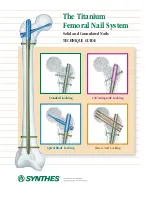 Preview for 1 page of Synthes The Titanium Femoral Nail System Technique Manual