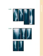 Preview for 10 page of Synthes The Titanium Femoral Nail System Technique Manual