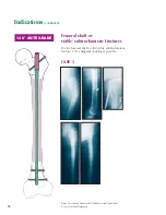 Preview for 11 page of Synthes The Titanium Femoral Nail System Technique Manual