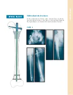 Preview for 12 page of Synthes The Titanium Femoral Nail System Technique Manual