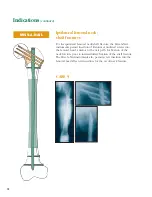 Preview for 13 page of Synthes The Titanium Femoral Nail System Technique Manual