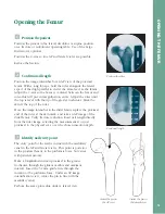 Preview for 16 page of Synthes The Titanium Femoral Nail System Technique Manual