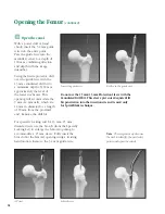 Preview for 17 page of Synthes The Titanium Femoral Nail System Technique Manual