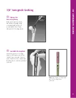 Preview for 32 page of Synthes The Titanium Femoral Nail System Technique Manual